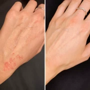 H_P_BEFORE-AFTER_1.webp
